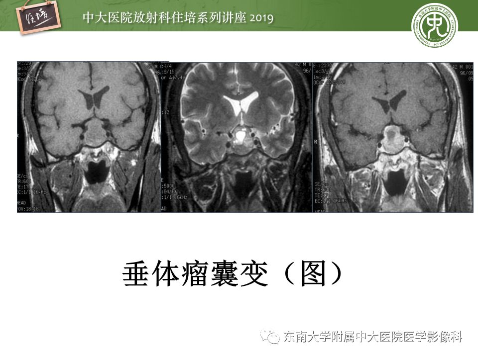 【PPT】垂体正常及常见疾病影像表现