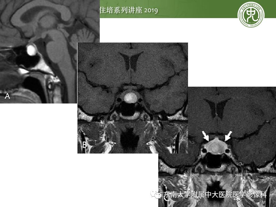 【PPT】垂体正常及常见疾病影像表现