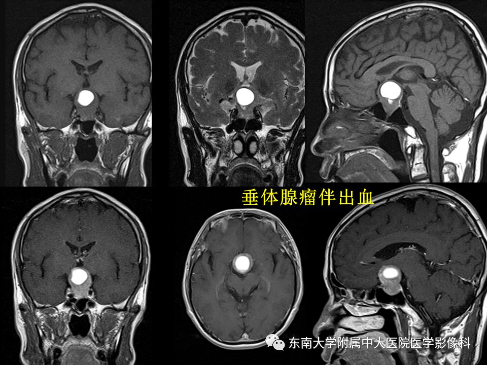 【PPT】垂体正常及常见疾病影像表现
