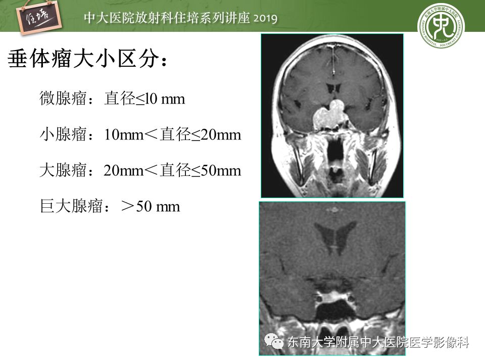 【PPT】垂体正常及常见疾病影像表现