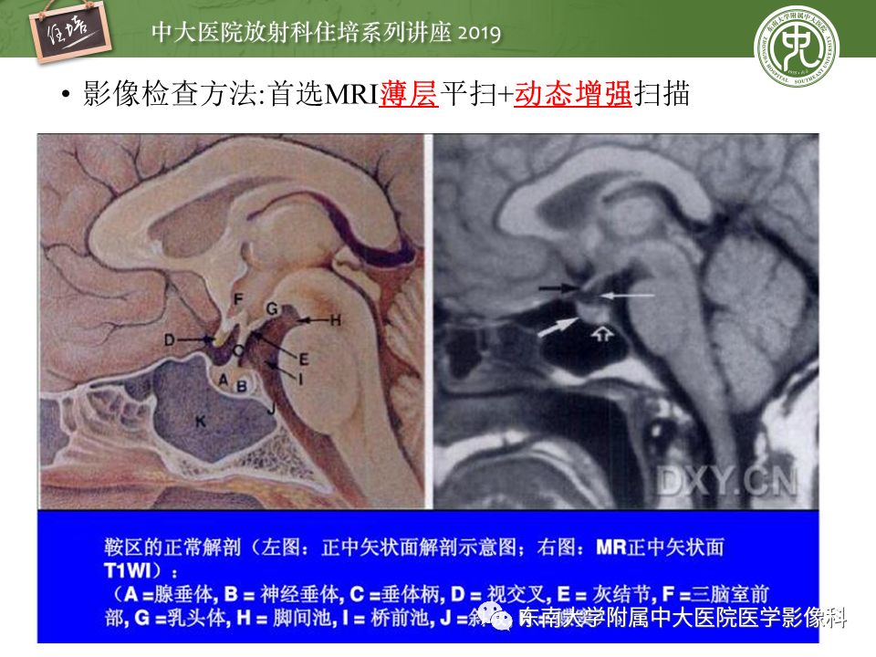 【PPT】垂体正常及常见疾病影像表现