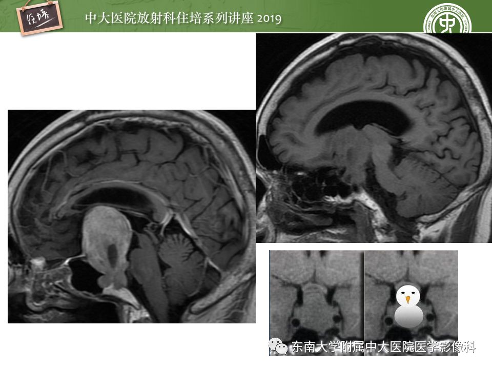 【PPT】垂体正常及常见疾病影像表现