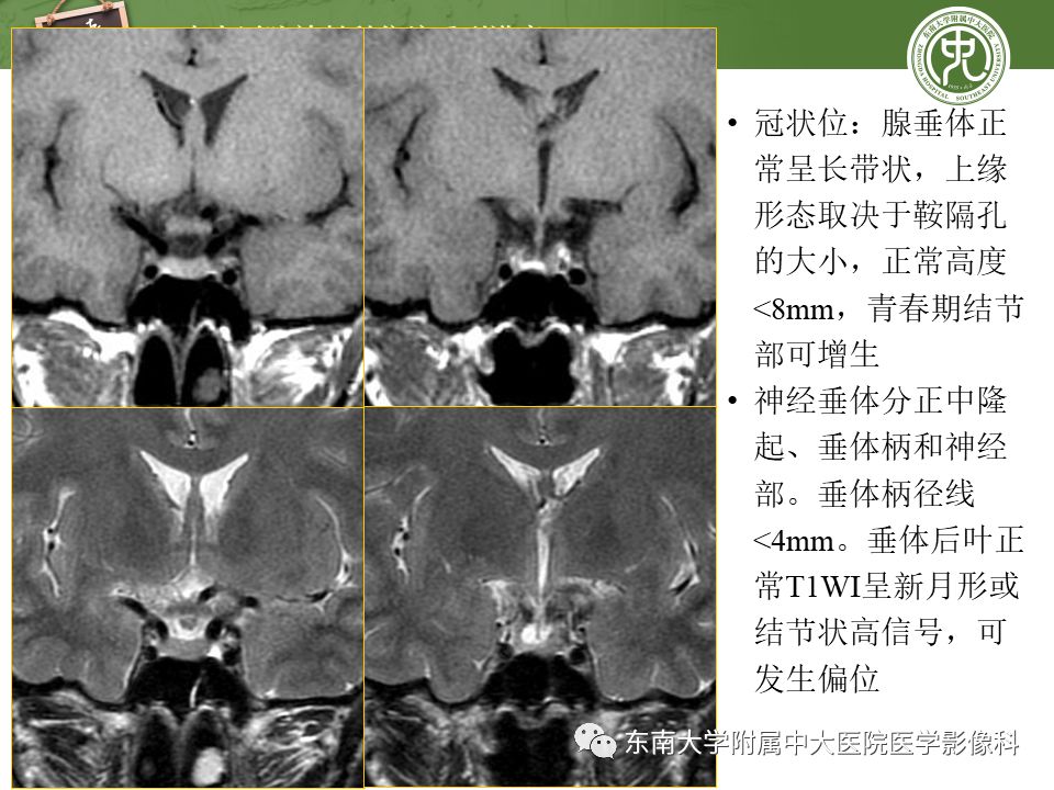 【PPT】垂体正常及常见疾病影像表现