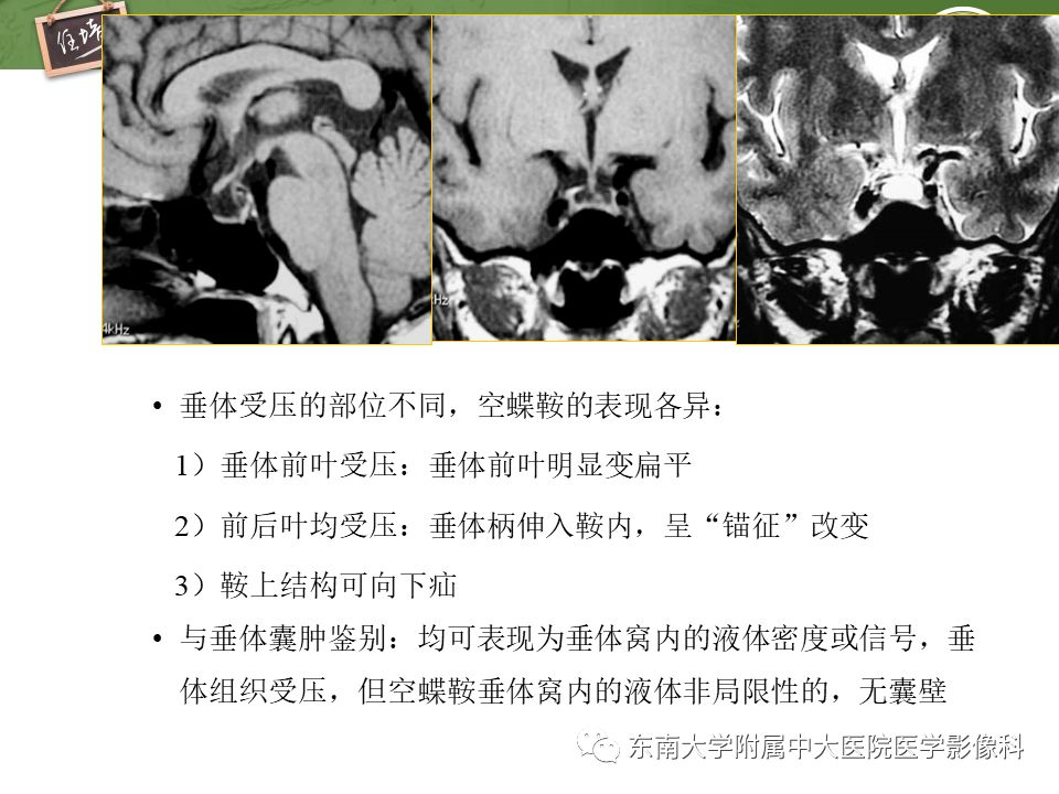 【PPT】垂体正常及常见疾病影像表现