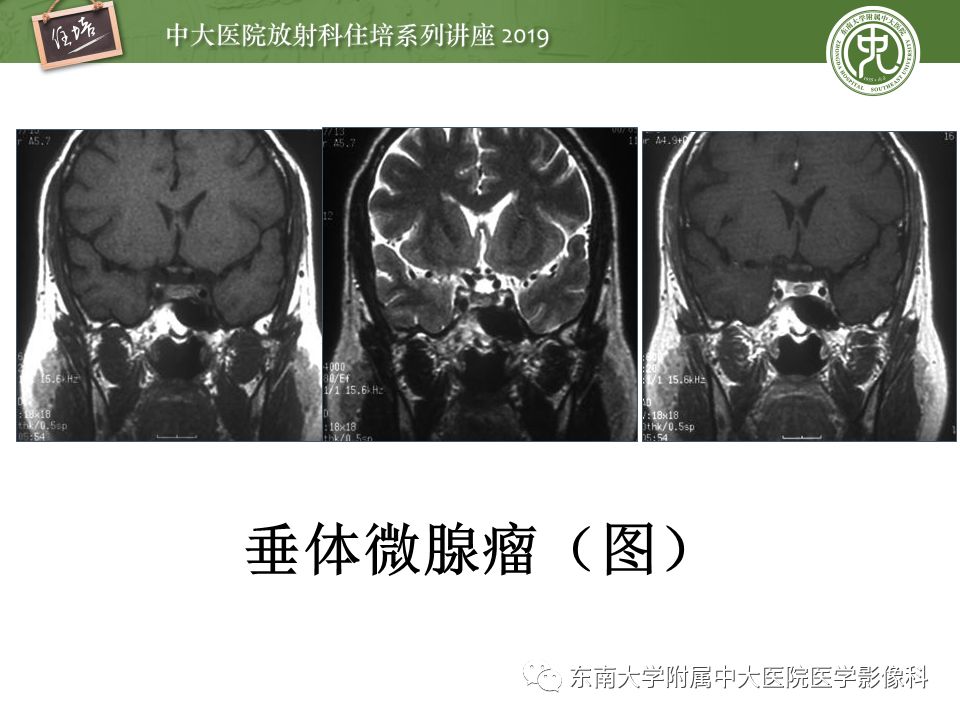 【PPT】垂体正常及常见疾病影像表现