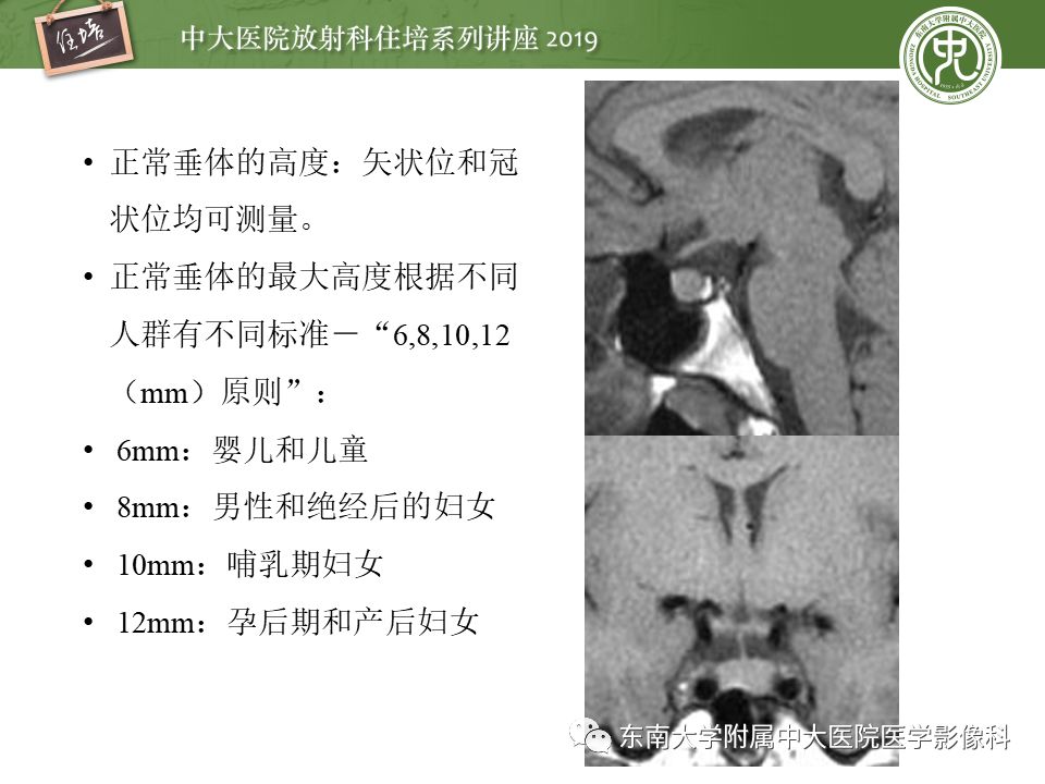 【PPT】垂体正常及常见疾病影像表现