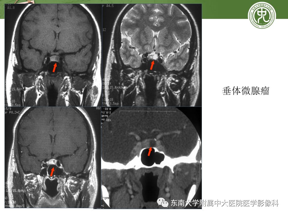【PPT】垂体正常及常见疾病影像表现