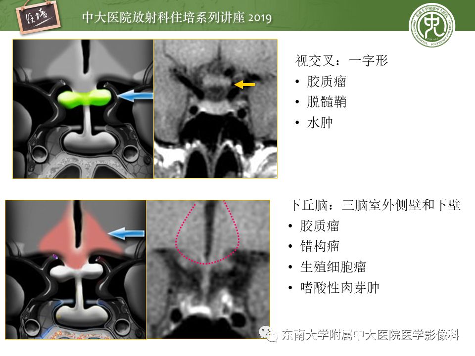 【PPT】垂体正常及常见疾病影像表现