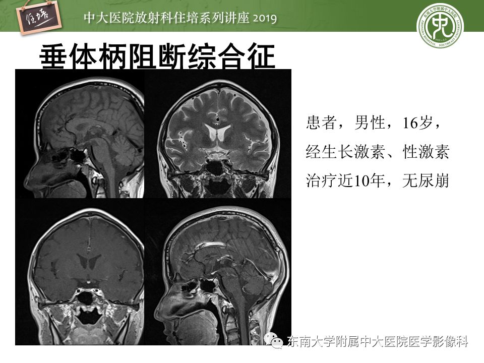 【PPT】垂体正常及常见疾病影像表现