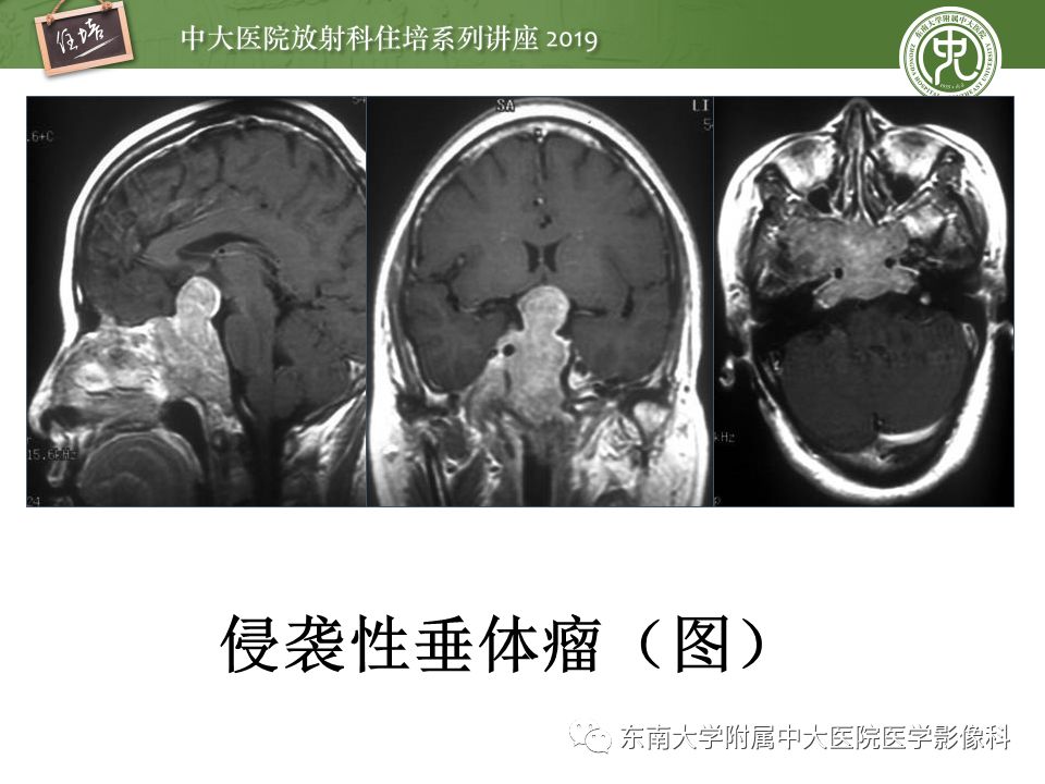 【PPT】垂体正常及常见疾病影像表现