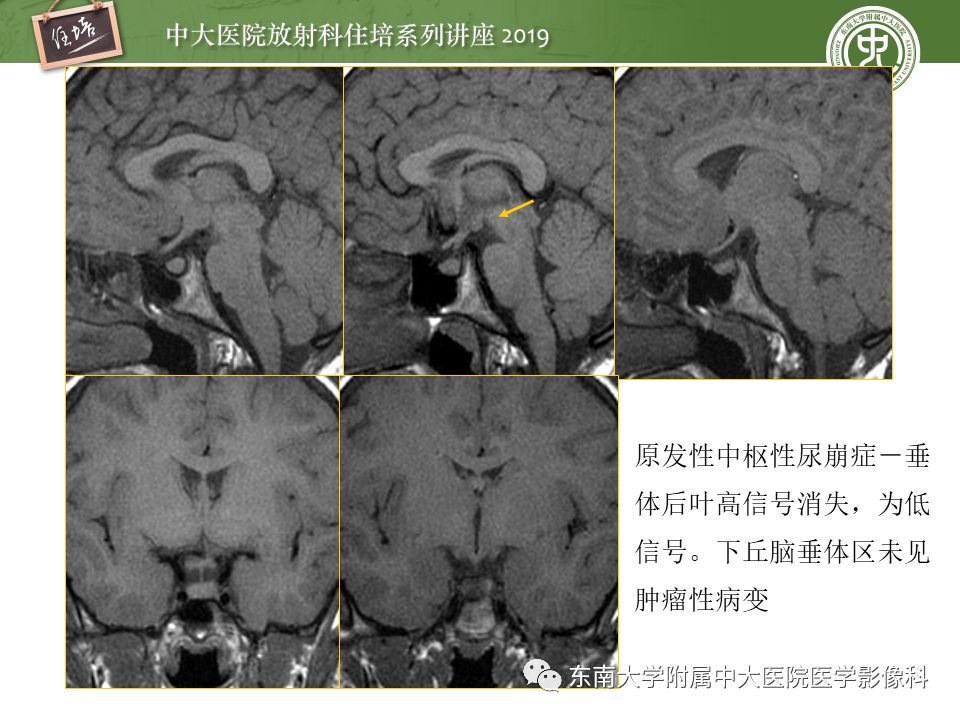 【PPT】垂体正常及常见疾病影像表现