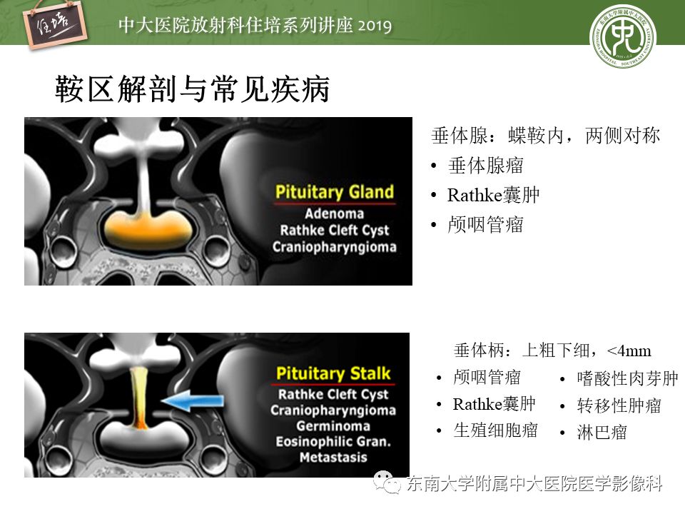 【PPT】垂体正常及常见疾病影像表现