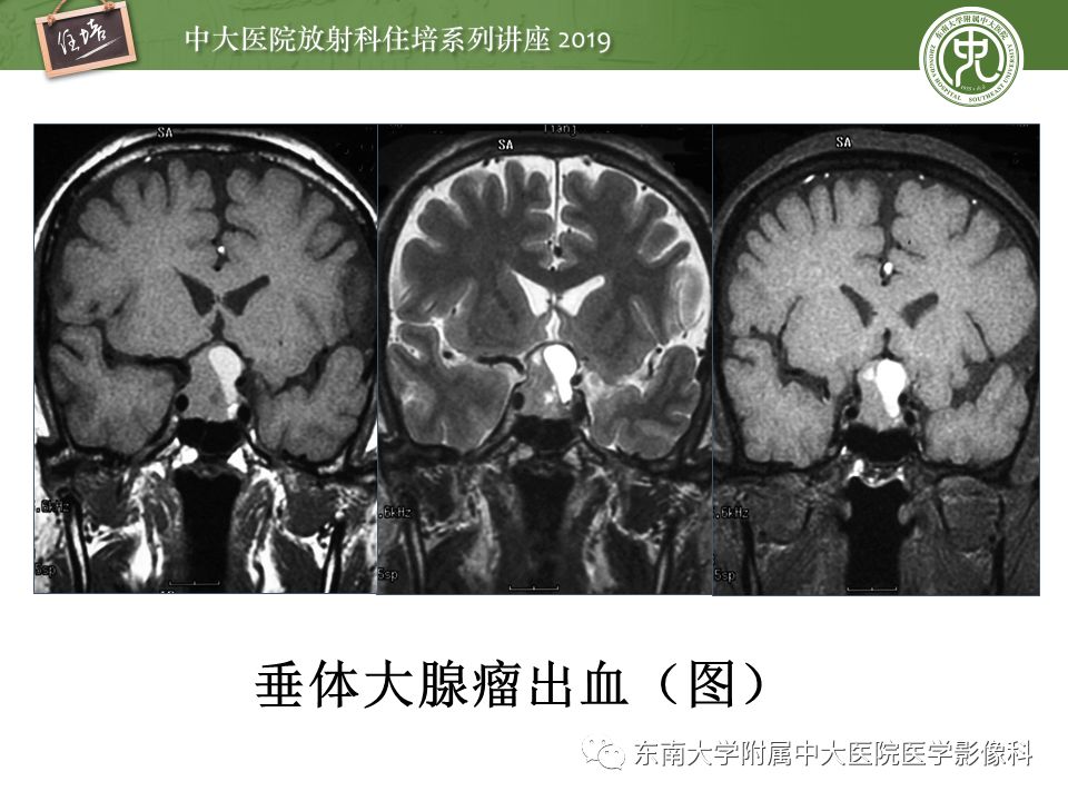 【PPT】垂体正常及常见疾病影像表现