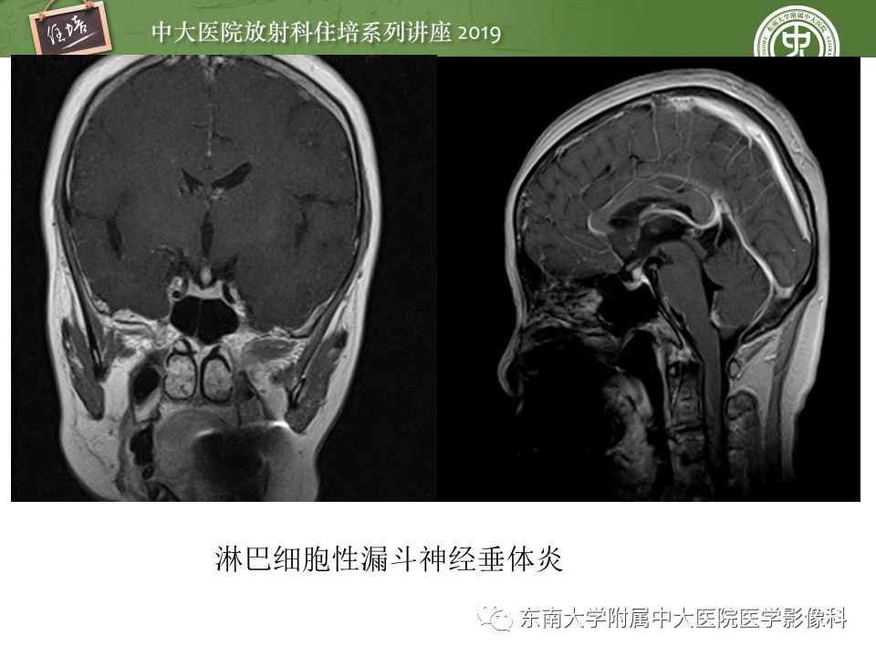 【PPT】垂体正常及常见疾病影像表现