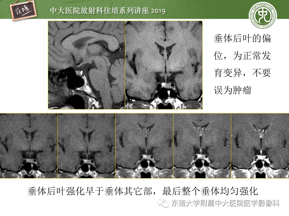 【PPT】垂体正常及常见疾病影像表现