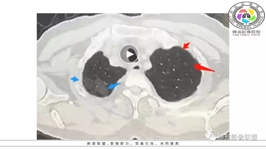 【PPT】病毒肺炎影像机制探讨