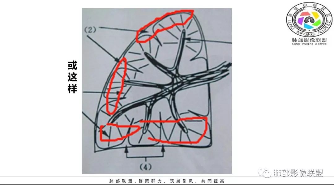 【PPT】病毒肺炎影像机制探讨