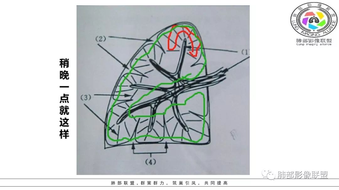 【PPT】病毒肺炎影像机制探讨