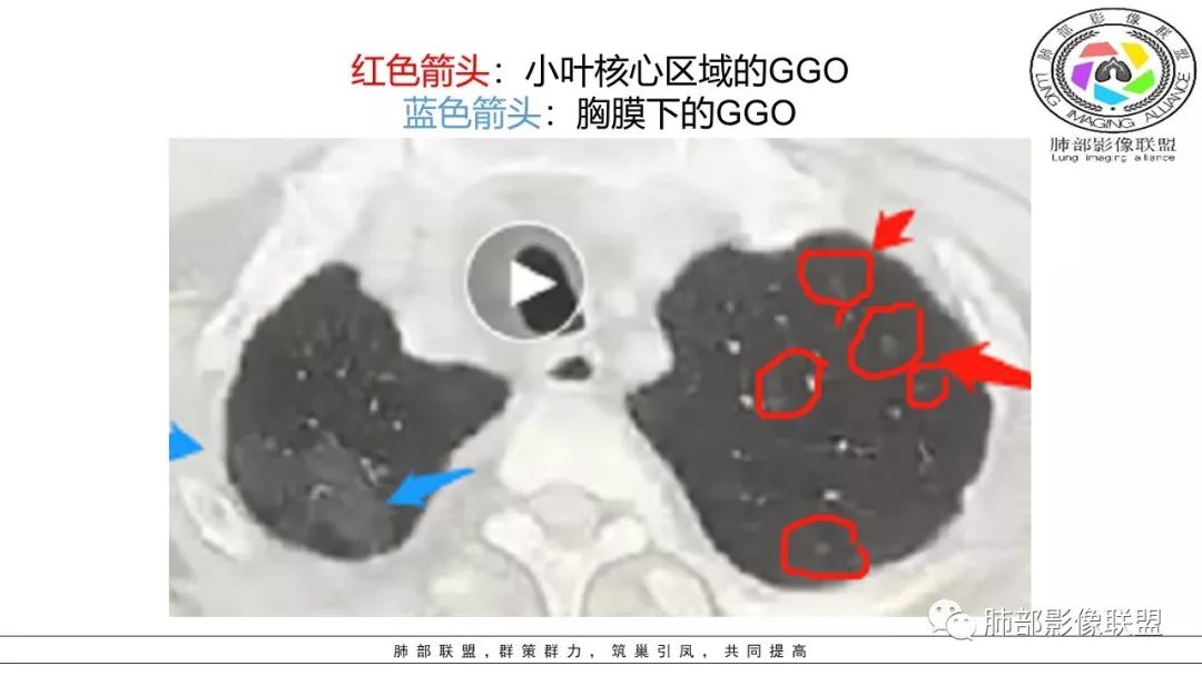 【PPT】病毒肺炎影像机制探讨