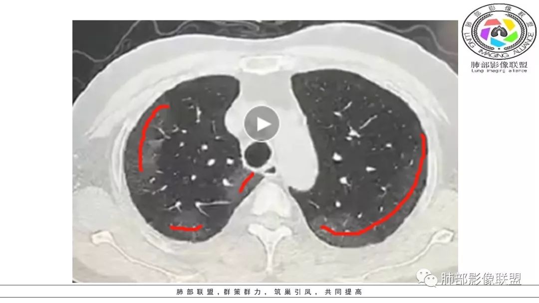 【PPT】病毒肺炎影像机制探讨