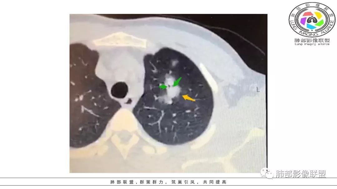 【PPT】病毒肺炎影像机制探讨