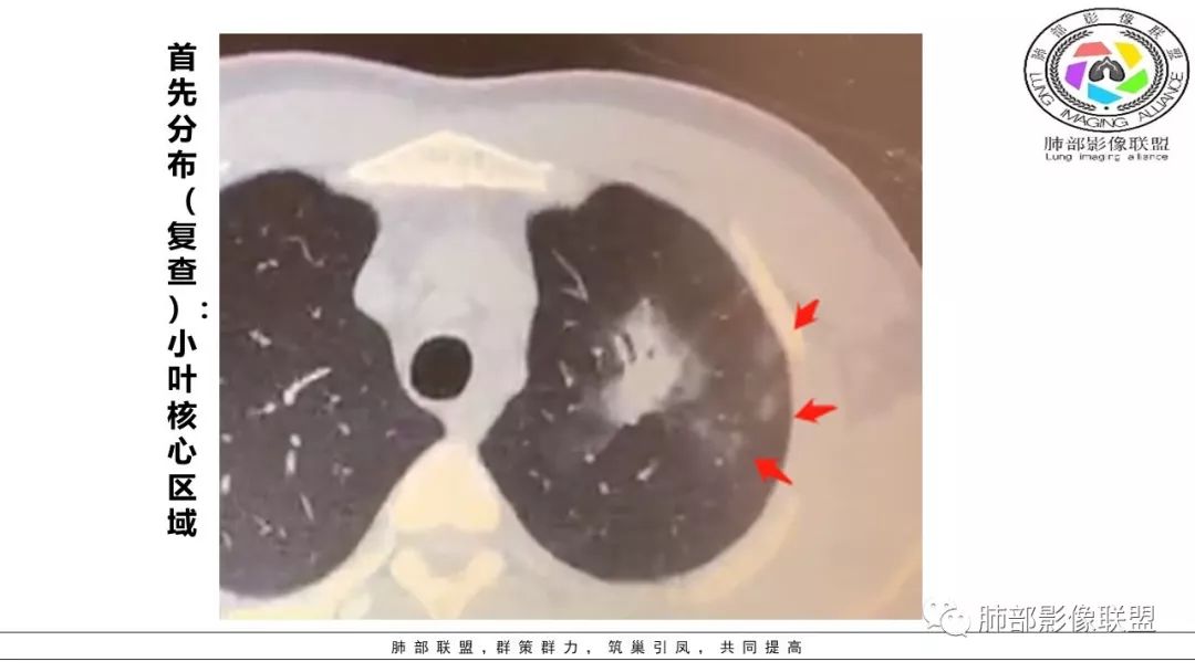 【PPT】病毒肺炎影像机制探讨