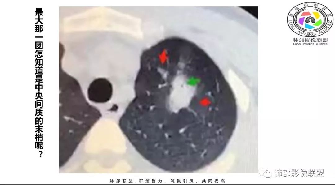 【PPT】病毒肺炎影像机制探讨