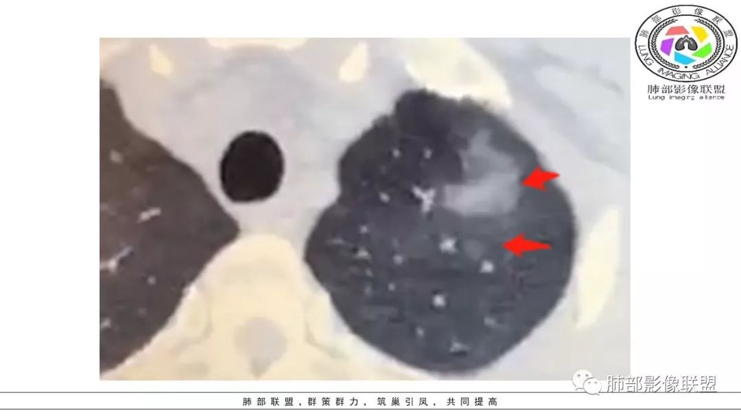 【PPT】病毒肺炎影像机制探讨