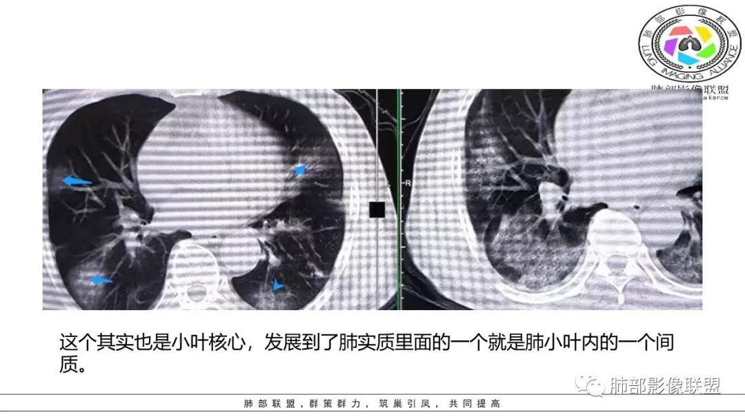 【PPT】病毒肺炎影像机制探讨