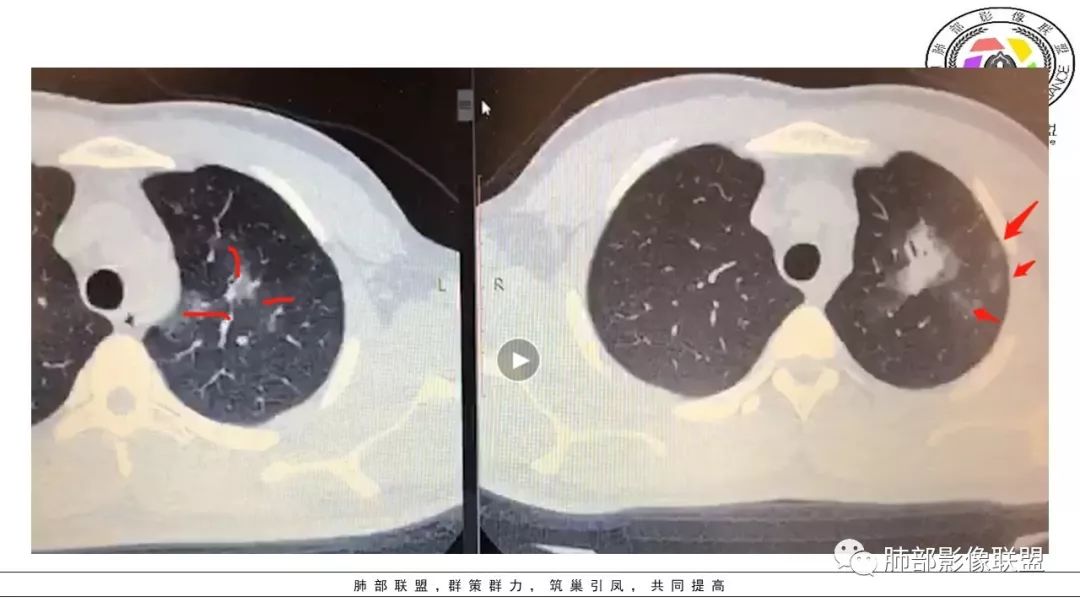 【PPT】病毒肺炎影像机制探讨
