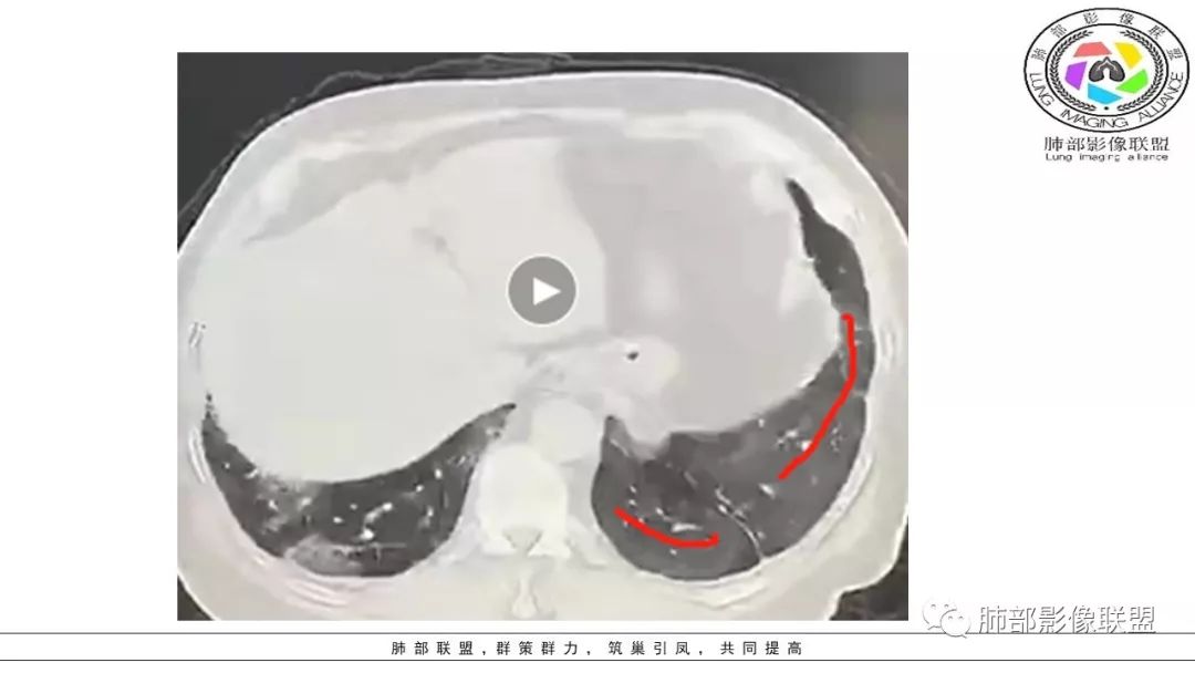【PPT】病毒肺炎影像机制探讨