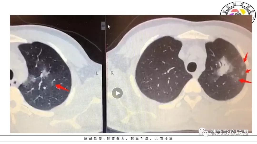 【PPT】病毒肺炎影像机制探讨