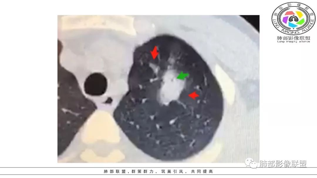 【PPT】病毒肺炎影像机制探讨