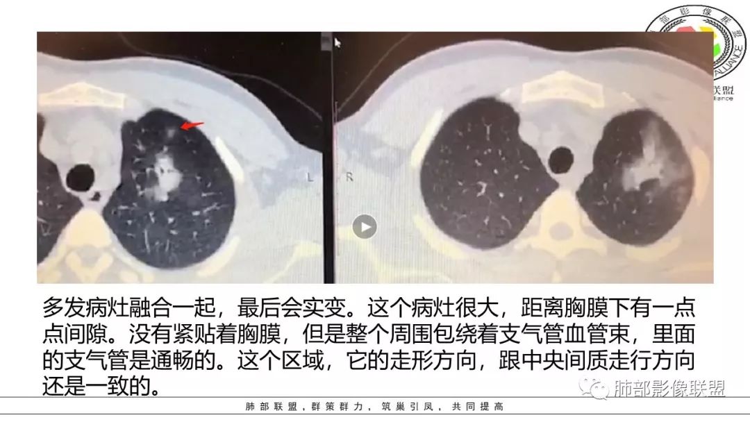 【PPT】病毒肺炎影像机制探讨
