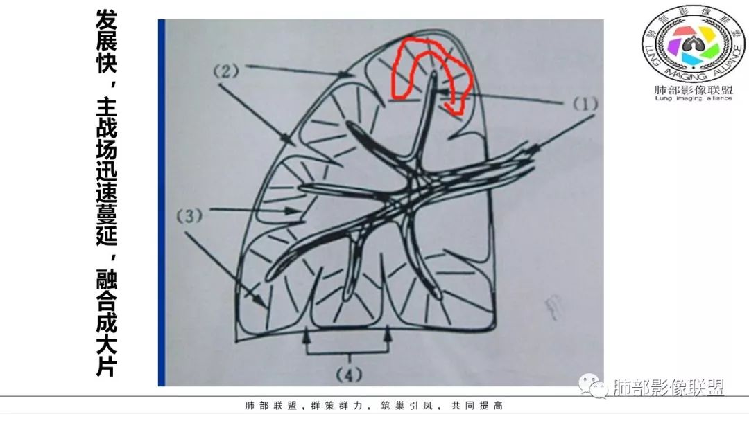 【PPT】病毒肺炎影像机制探讨