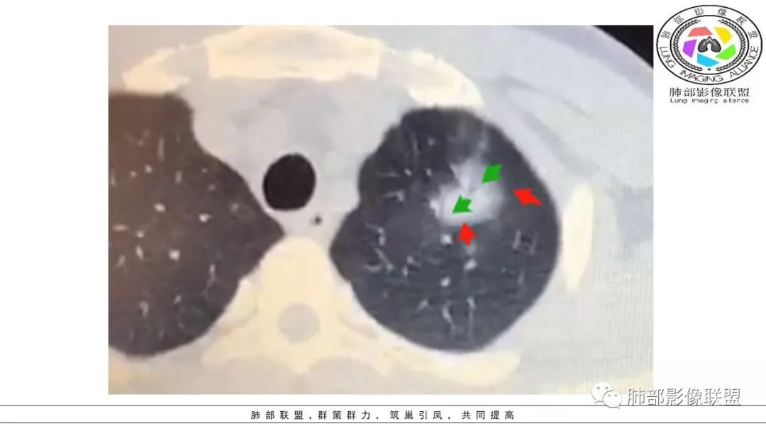 【PPT】病毒肺炎影像机制探讨