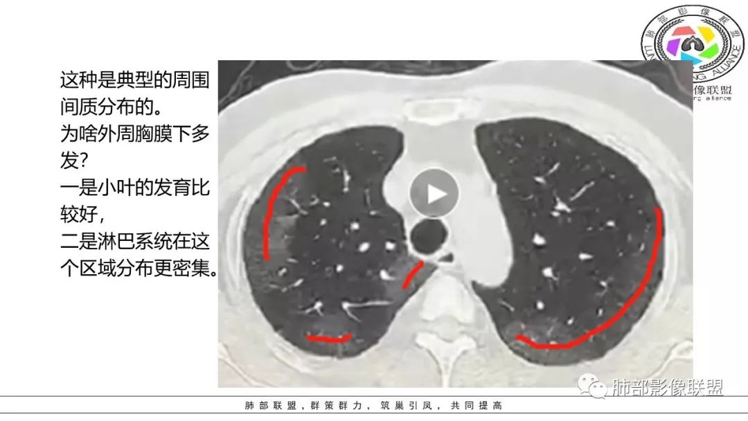 【PPT】病毒肺炎影像机制探讨