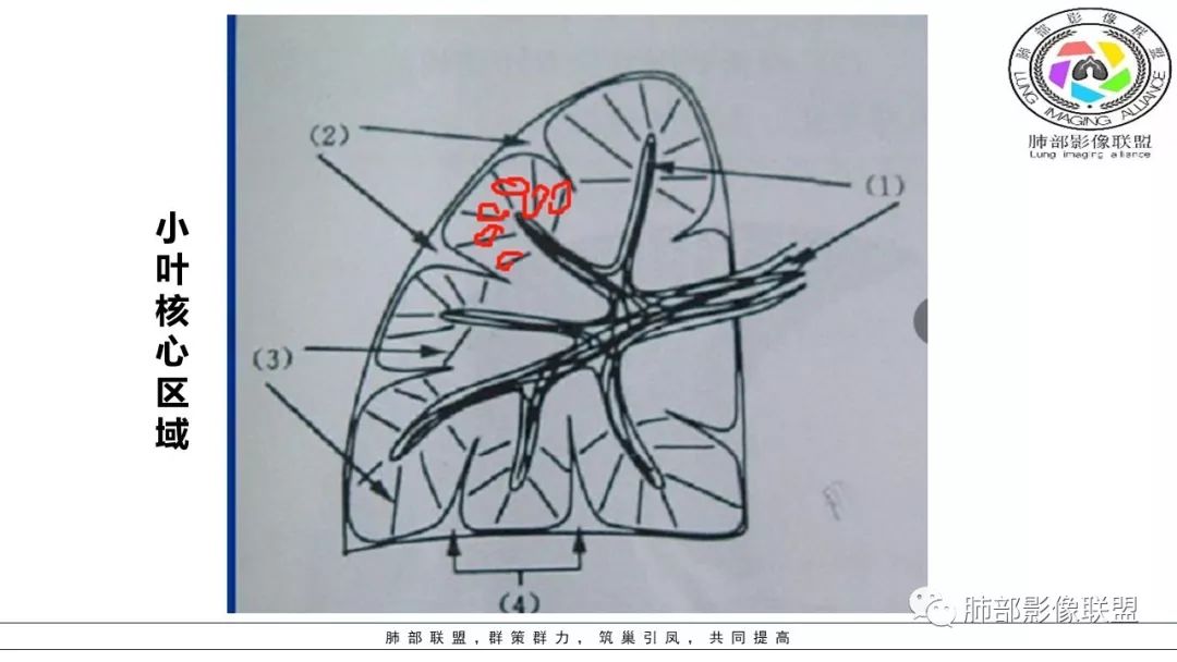 【PPT】病毒肺炎影像机制探讨