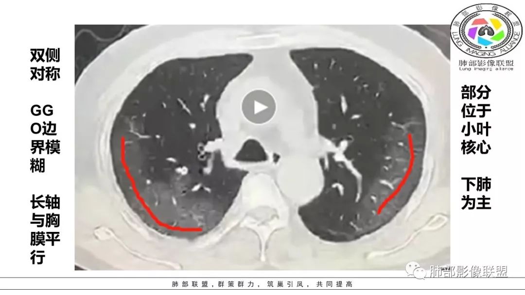 【PPT】病毒肺炎影像机制探讨