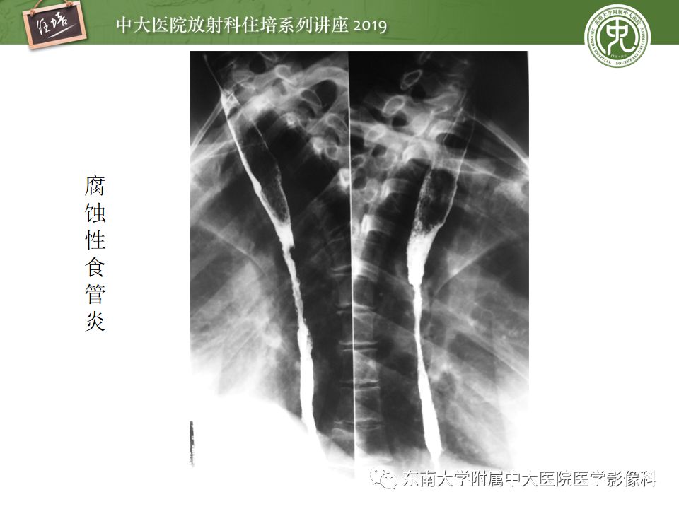 【PPT】食管常见疾病的诊断和鉴别诊断