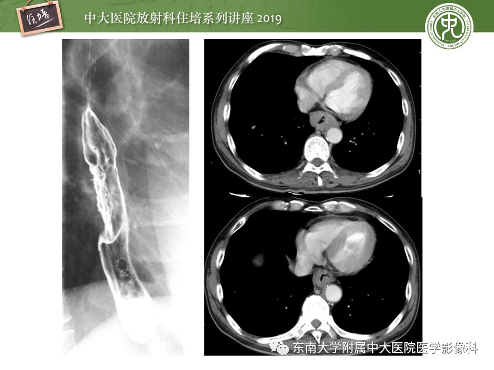 【PPT】食管常见疾病的诊断和鉴别诊断