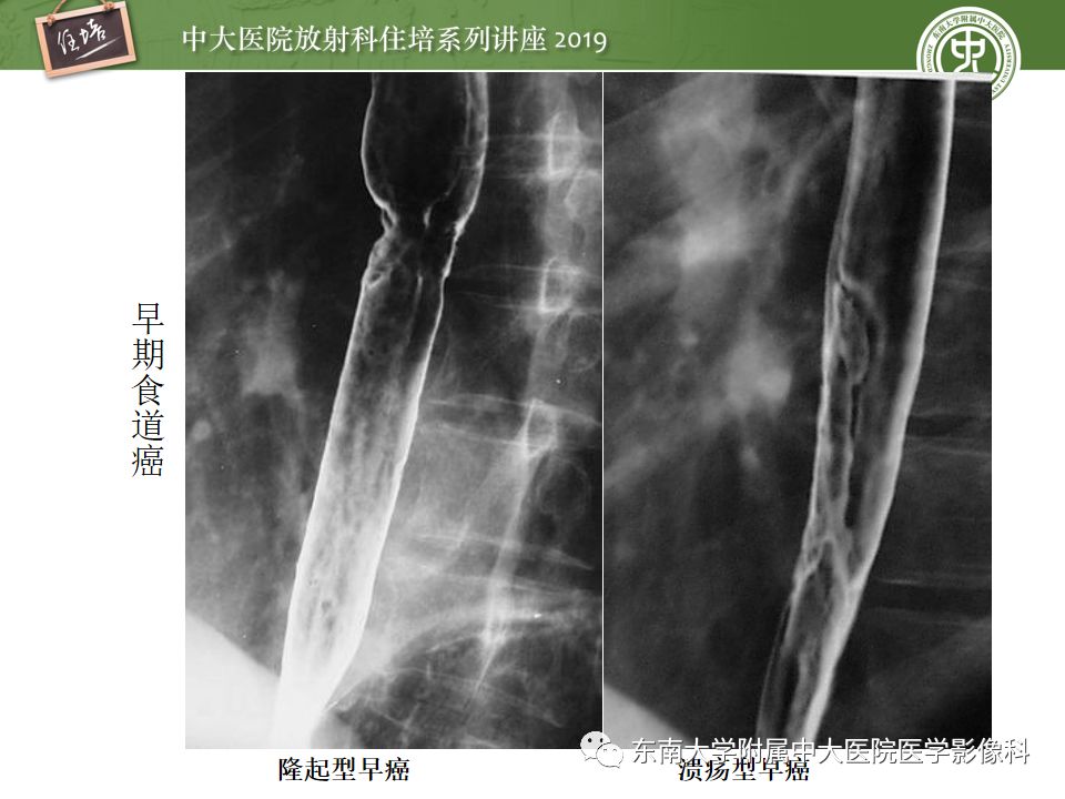 【PPT】食管常见疾病的诊断和鉴别诊断