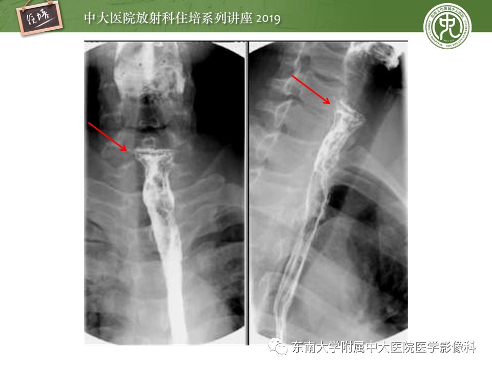 【PPT】食管常见疾病的诊断和鉴别诊断
