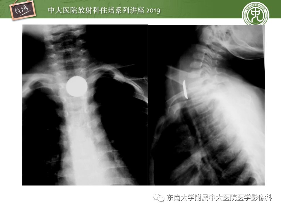 【PPT】食管常见疾病的诊断和鉴别诊断
