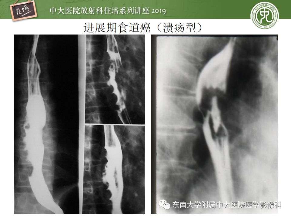 【PPT】食管常见疾病的诊断和鉴别诊断