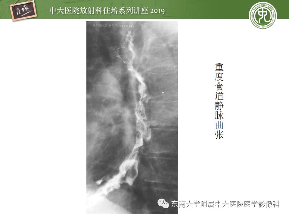 【PPT】食管常见疾病的诊断和鉴别诊断