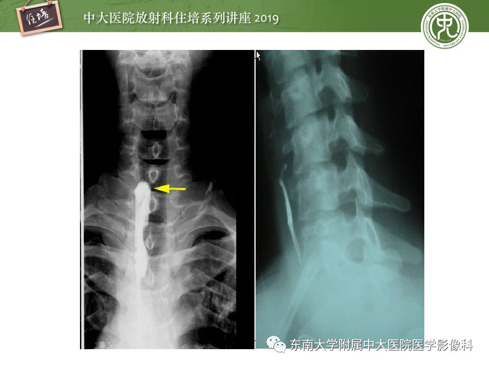 【PPT】食管常见疾病的诊断和鉴别诊断