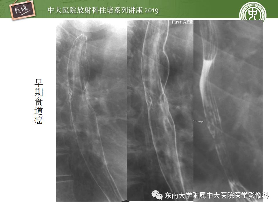 【PPT】食管常见疾病的诊断和鉴别诊断