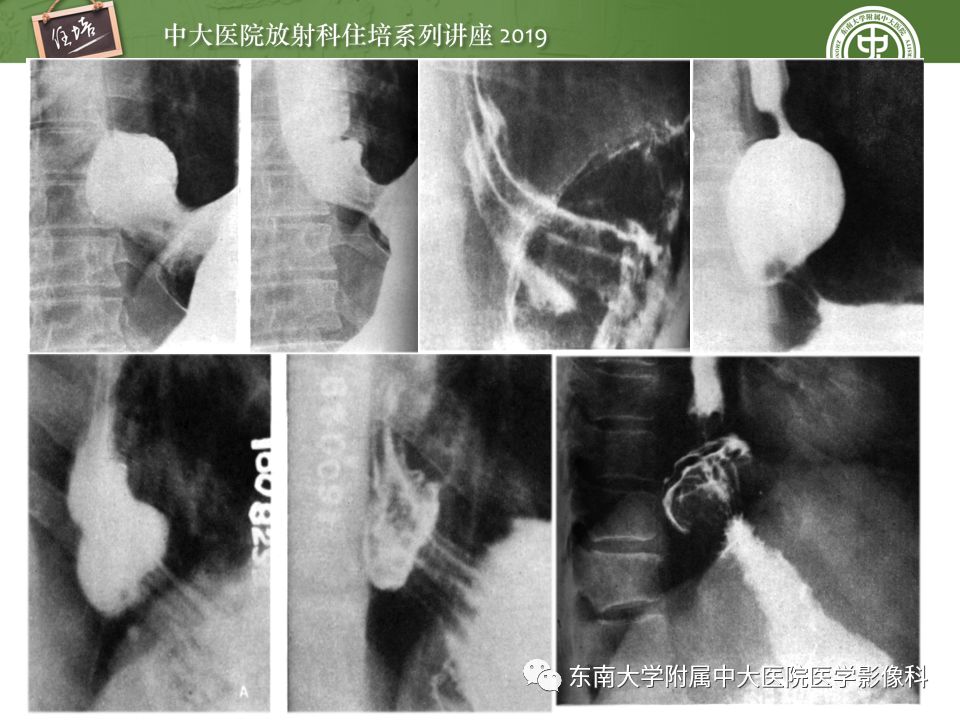 【PPT】食管常见疾病的诊断和鉴别诊断