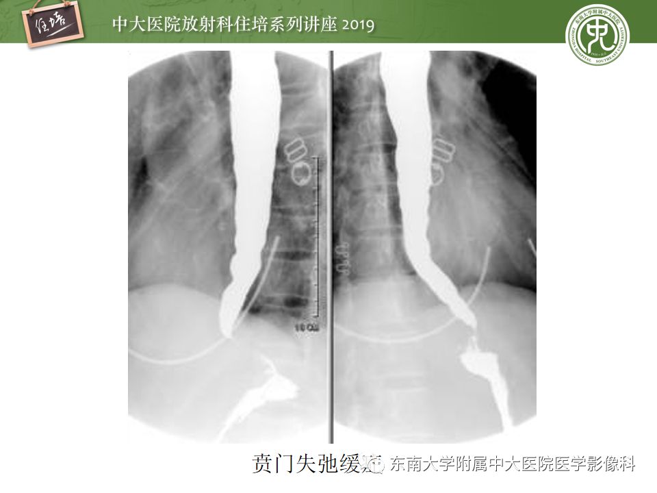 【PPT】食管常见疾病的诊断和鉴别诊断
